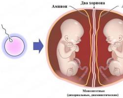 Как беременеют двойней: предрасполагающие факторы, течение беременности