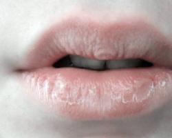 Обветренные губы: быстрое лечение в домашних условиях