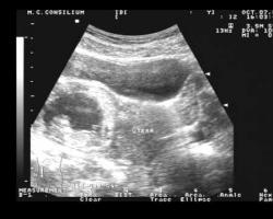 Покажет ли внематочную беременность на УЗИ: как она выглядит в яичнике и в других местах локализации Трубная беременность узи